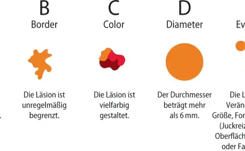 Die entscheidenden Schritte zur effektiven Melanom-Diagnostik verstehen