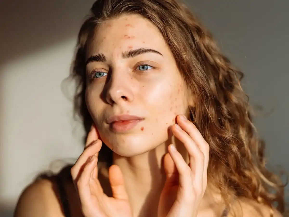 Isotretinoin Nebenwirkungen - was hilft und was gefährlich ist