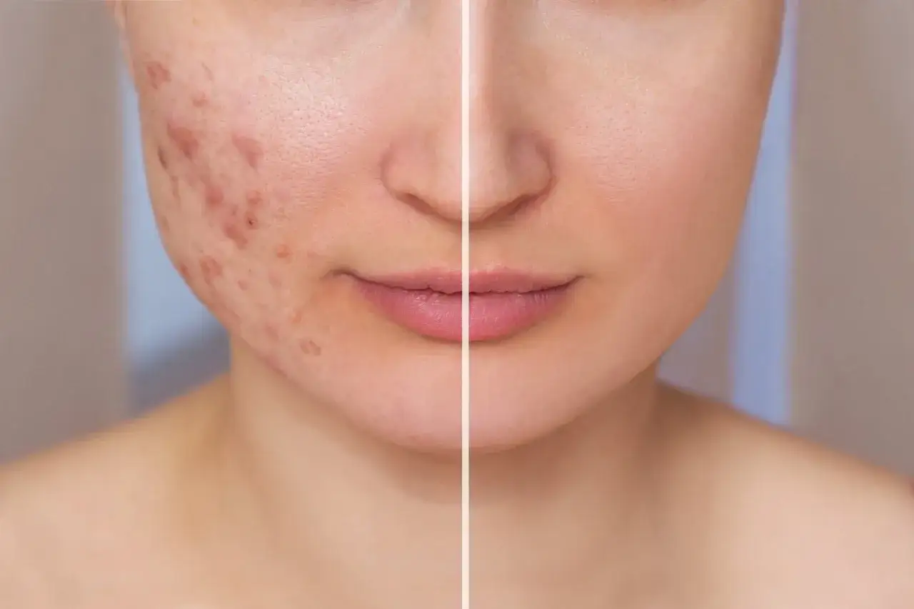 Vorher-Nachher-Vergleich: Akne-Narben auf der linken Seite, reine Haut auf der rechten Seite nach der Behandlung mit Isotretinoin.